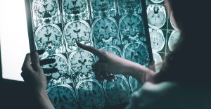 Investigan posible vínculo de la Covid con el mal de Alzheimer